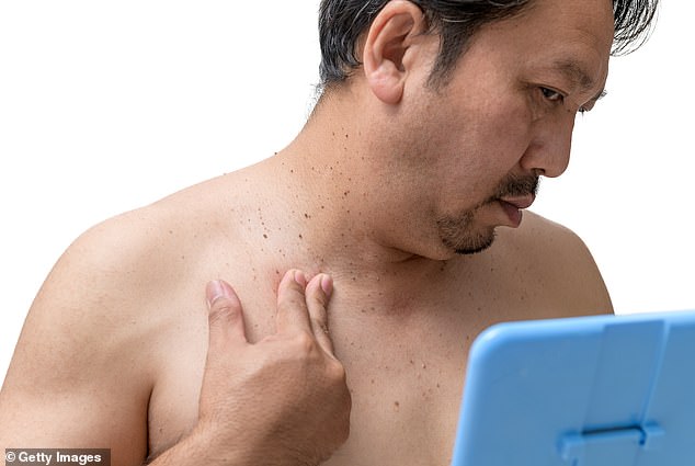 Skin Tags May Signal Hidden Health Risks Like Insulin Resistance