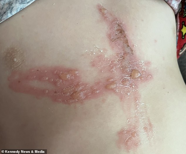Six-year-old boy hospitalized with severe burns after playing with giant hogweed in Kent.