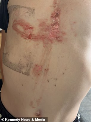Six-year-old boy hospitalized with severe burns after playing with giant hogweed in Kent.