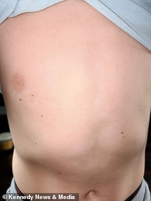 Six-year-old boy hospitalized with severe burns after playing with giant hogweed in Kent.