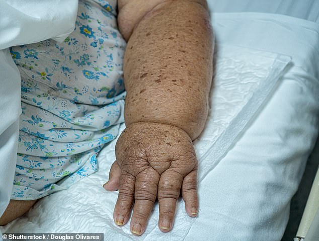 New study suggests breast cancer patients may safely skip surgery to avoid lymphedema.