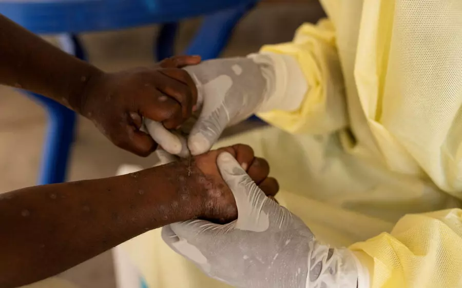 Mpox : l’inquiétude grandit face à la résurgence de cas en Europe et en Afrique